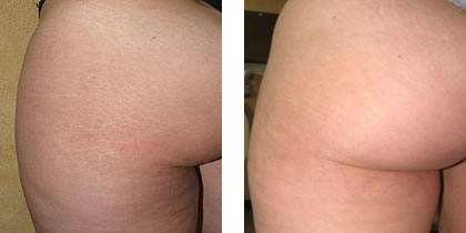 How Many Stretch Marks Are Normal During Pregnancy