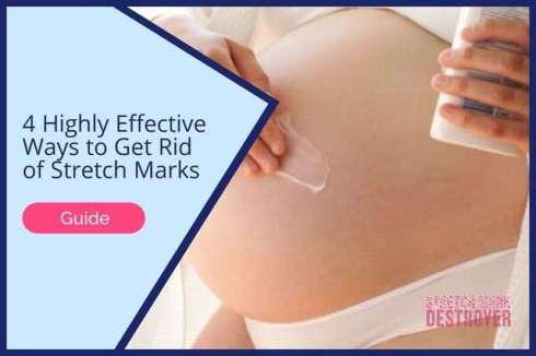 What Can Help Remove Stretch Markss